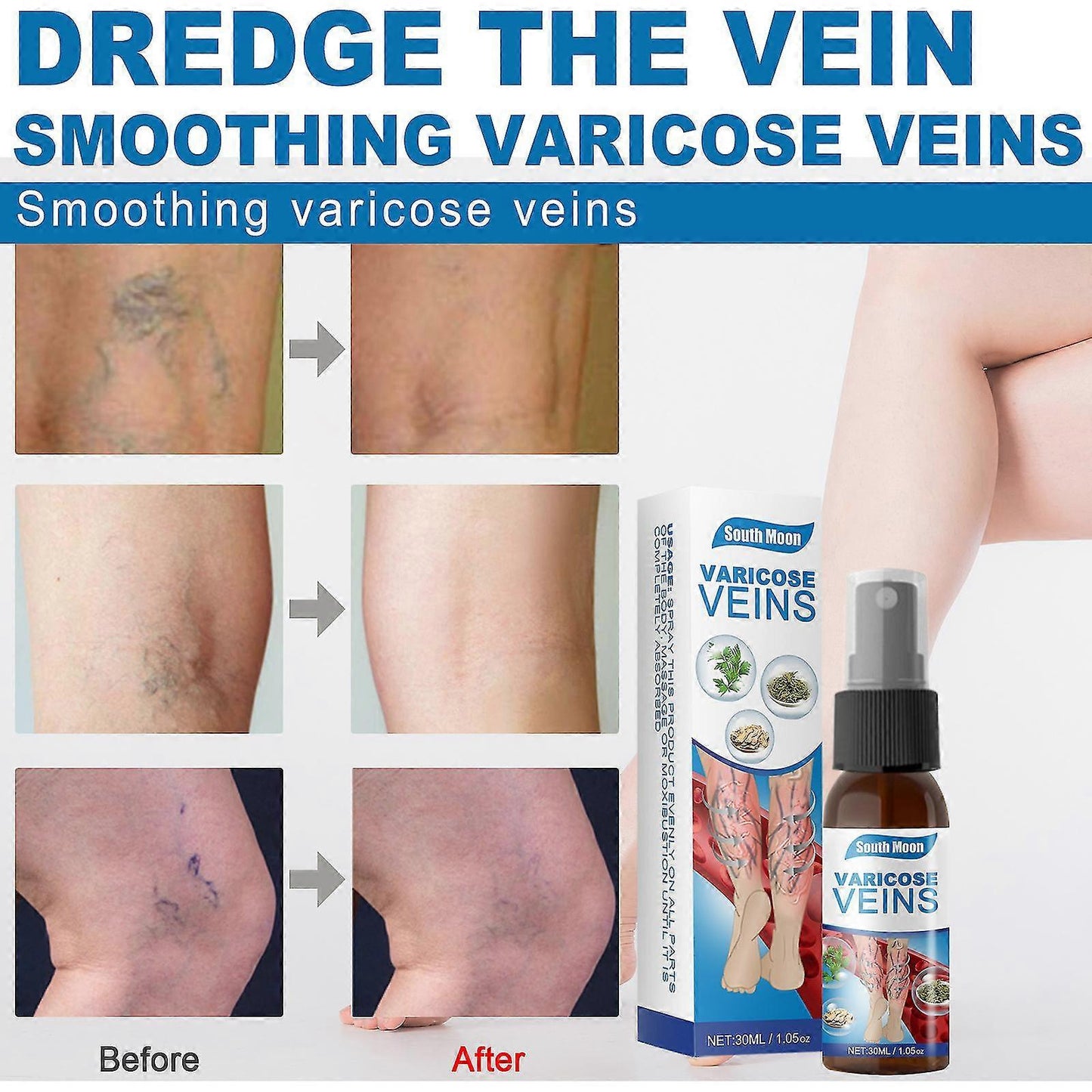 🔥HOT SALE 50% OFF🔥 Varicose Veins Relief Spray