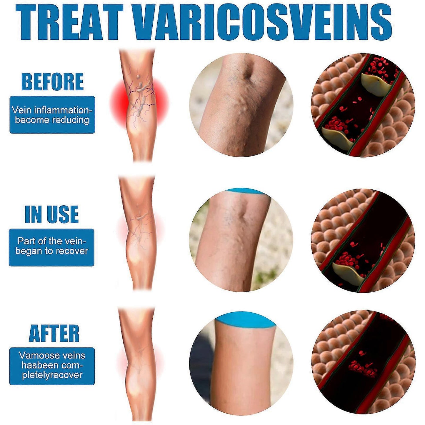 🔥HOT SALE 50% OFF🔥 Varicose Veins Relief Spray