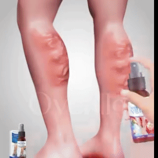 🔥HOT SALE 50% OFF🔥 Varicose Veins Relief Spray